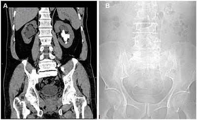 Distal end of a ureteral double-J stent displaced into the contralateral ureter after percutaneous nephrolithotripsy: a case report